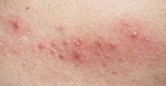 女性艾滋病早期症状