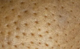 乳腺癌的早期症状和前兆