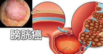膀胱癌转移了还能活多久
